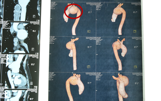 哈医大二院成功实施"杂交手术"解除主动脉弓部动脉瘤危机