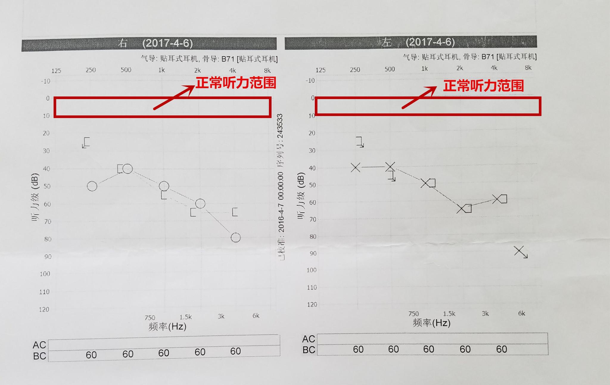 因婚礼噪声太大 致使湖南男子听力受损