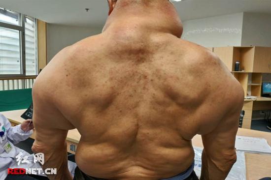 老人身上数十个大小不一的脂肪块就像“绿巨人”的肌肉。