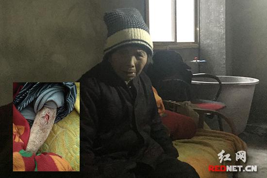 胡小玉坐在床上孤苦无依的样子。掀起裤腿,我们看到了她干枯的淌着血的小腿。