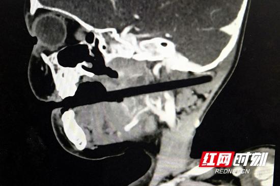 筷子插入患儿颅内长达10厘米，但万幸未伤及脑干、颈动脉和颈椎等重要组织。