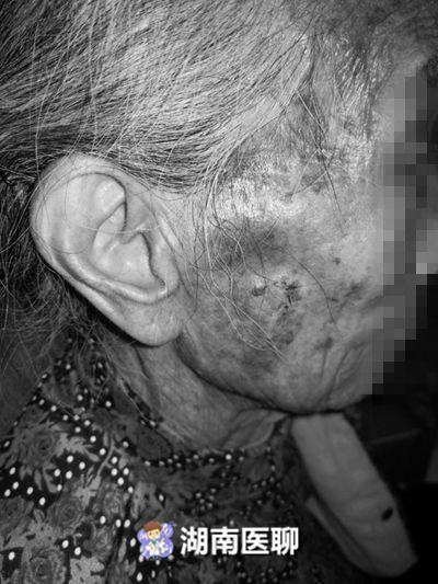 常德老太脸上 老年斑 脱屑结痂痒不停 一查竟是