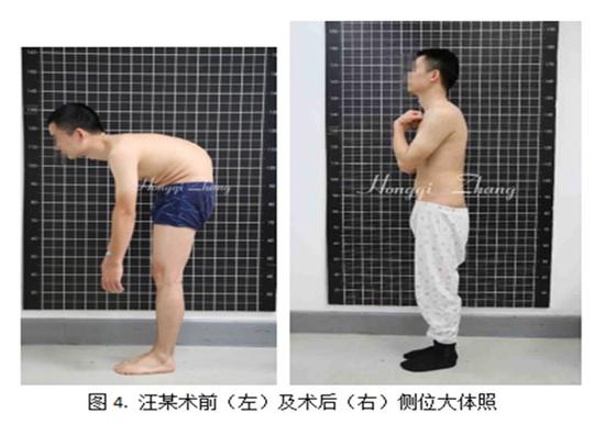 小伙驼背十几年“掰直”了！曾俯身背驼超过90度