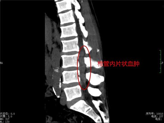 娄底一65岁老人突发罕见急症 一天内双下肢瘫痪