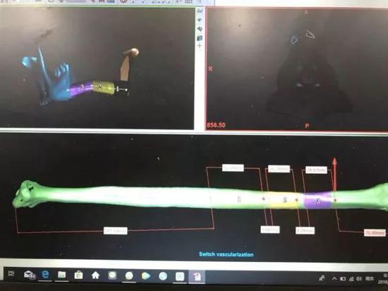 利用3D打印技术制成1:1的下颌骨模型、腓骨模型
