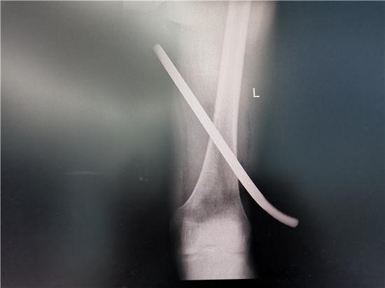 男子从1米高的地方坠落 钢筋贯穿大腿险丧命