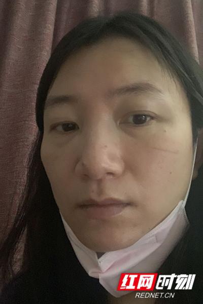 未管所李琼,口罩取下很久后脸上仍有压痕。