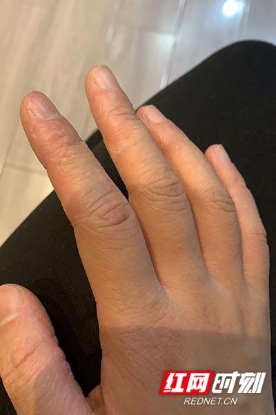 在手套里闷了72小时后,朱泽莉手上长满了水泡。