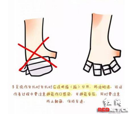 手足烧烫伤要避免粘连。