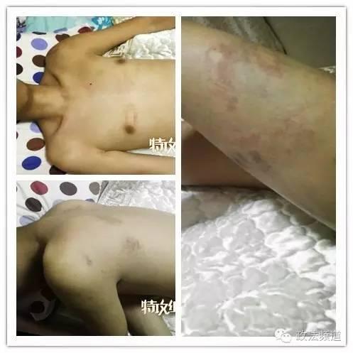 男孩到长沙一特训学校培训 结果被打得遍体鳞伤