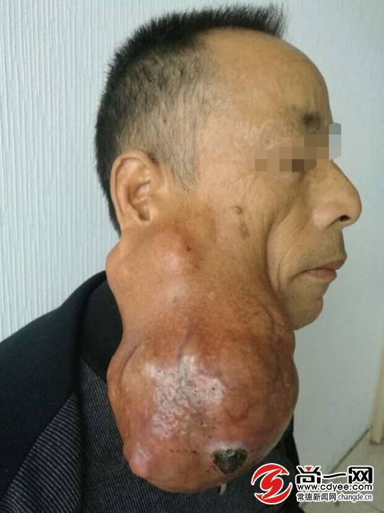 常德一男子腮腺长"幼童头" 大肿瘤 成功摘除面部神经保住