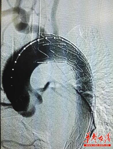 主动脉支架植入后影像。