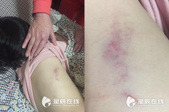 (陈女士的孩子身上的伤处,背部。)