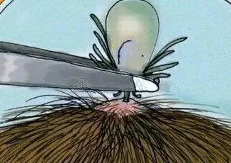 长沙5岁娃后脑勺痛 家长拨开头发一看魂都吓掉