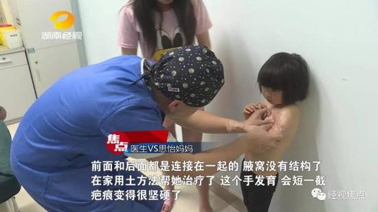 医生介绍,虽然小思怡烧伤比较严重,但是如果及时治疗,经过多次手术,就会恢复。