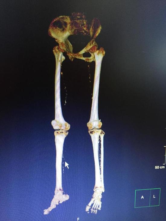 CTA检查显示下肢血管堵塞严重。