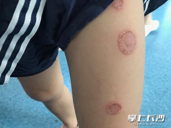 与猫咪太亲密，刘先生的女儿患上了猫癣。