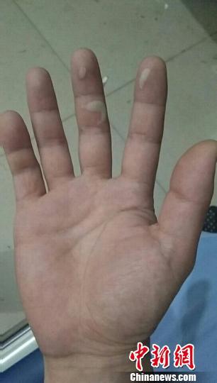 图为灰山港派出所彭志敏被烫伤右手 禹趣 摄