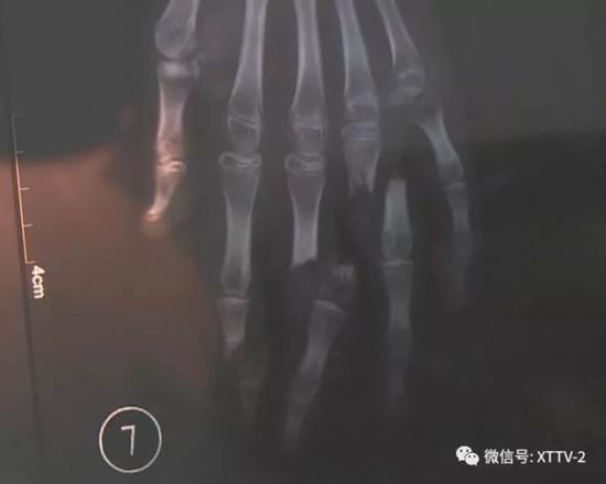 看到女儿血肉模糊的左手,郭敏的父亲心急如焚,孩子受了这么重的伤,很可能会影响以后的正常生活。