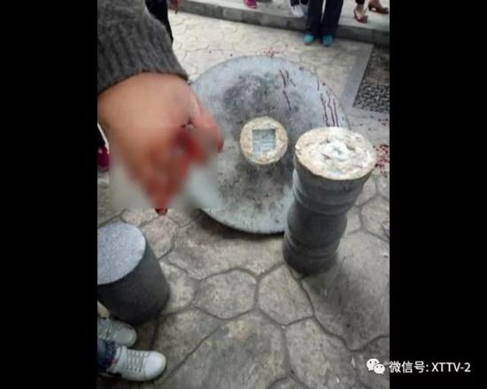 上百斤石桌突然倒下 砸断女孩三根手指