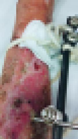 整条腿溃烂面临截肢的危险