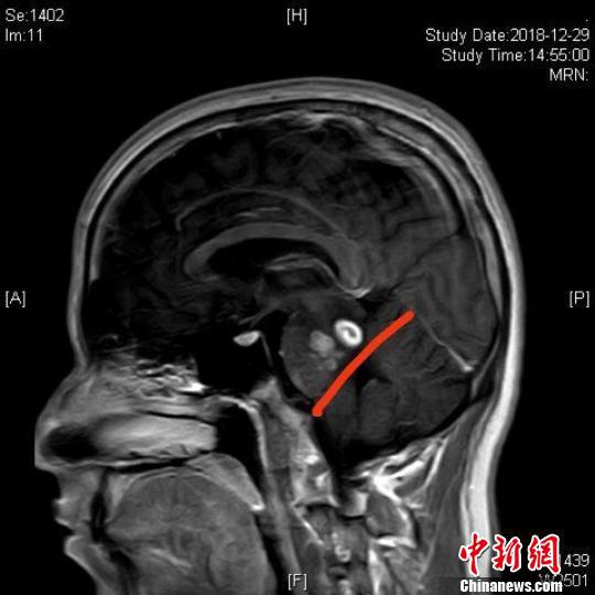  图为患者头部核磁共振影像，红色标记线上方的白色区域为寄生虫。　长沙市中心医院供图