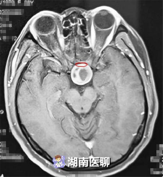 （垂体受肿瘤挤压变得菲薄）