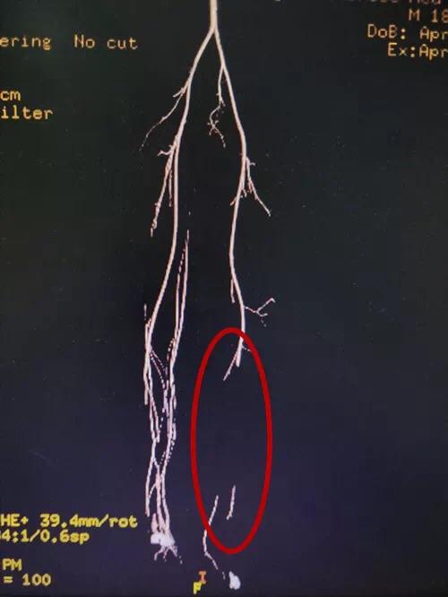 长沙18岁小伙车间实习被1吨重物砸伤 紧急手术保住小腿