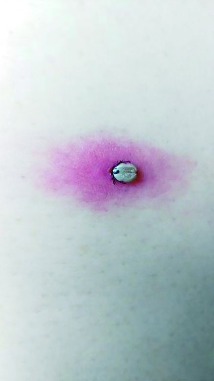 扎入皮肤之后,吸血的蜱虫变成肤色。 受访者 供图