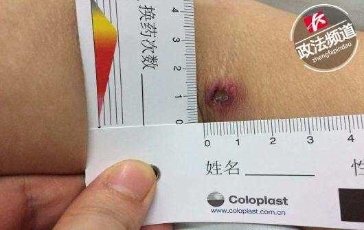 长沙女子肝肾功能衰竭险丧命！只因被这种小虫咬了一口....