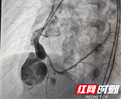 封堵后造影情况。