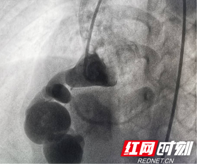 封堵前造影情况。
