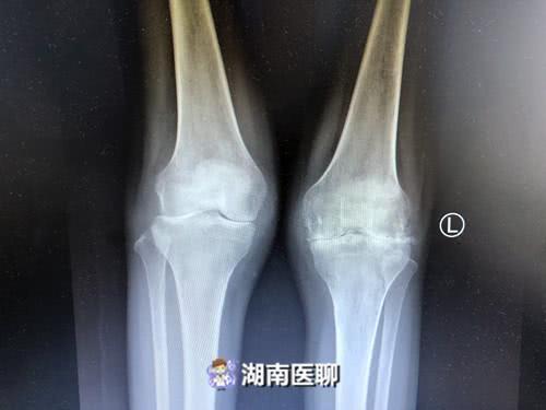 (患者双膝关节间隙严重狭窄)