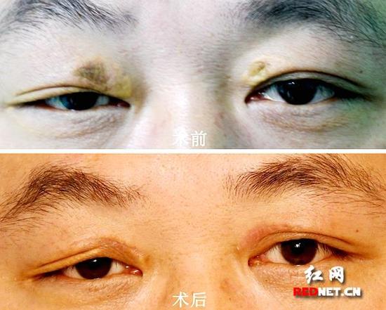 谢大叔手术前后对比。