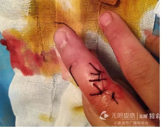 民警刘志风的左手也在医院进行了缝合处理,对于救人受伤他表示并不后悔。