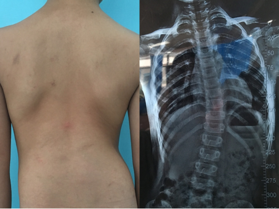 当“吃鸡游戏”遇上葛优躺 小心脊柱侧弯!