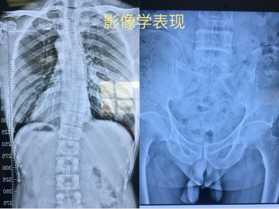 当“吃鸡游戏”遇上葛优躺 小心脊柱侧弯!