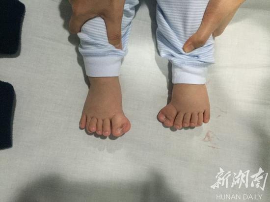 湖南1岁男童手脚多了6个指头