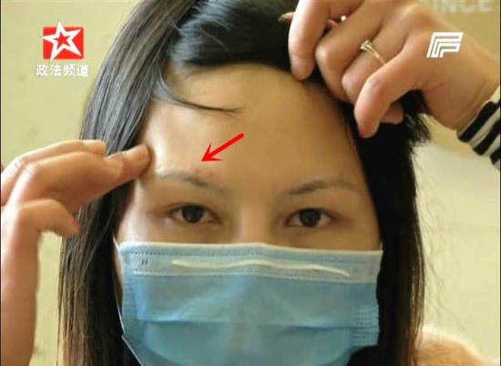 而为了掩饰这条伤疤,张女士需要终身纹眉。