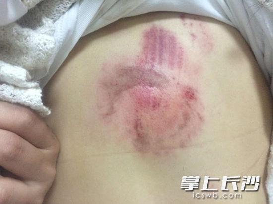 尹同学背部被马咬到后，伤口皮肤已经破损。 长沙晚报记者 聂映荣 摄
