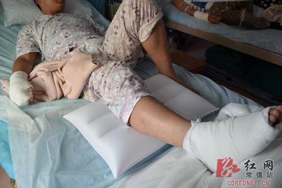 石门县的27岁小伙钓鱼时遭高压电穿身过，四肢轻度电烧伤