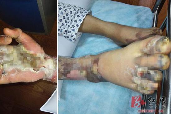 安乡23岁小伙小杨钓鱼时遭电击，右手肌体组织坏死，不得不截肢