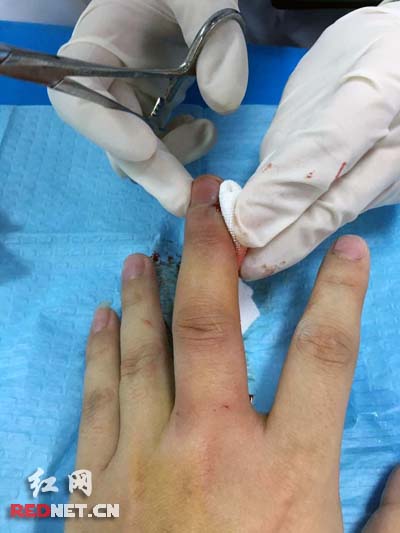 市民杨先生宵夜时被虾壳刺伤手指,伤口化脓后