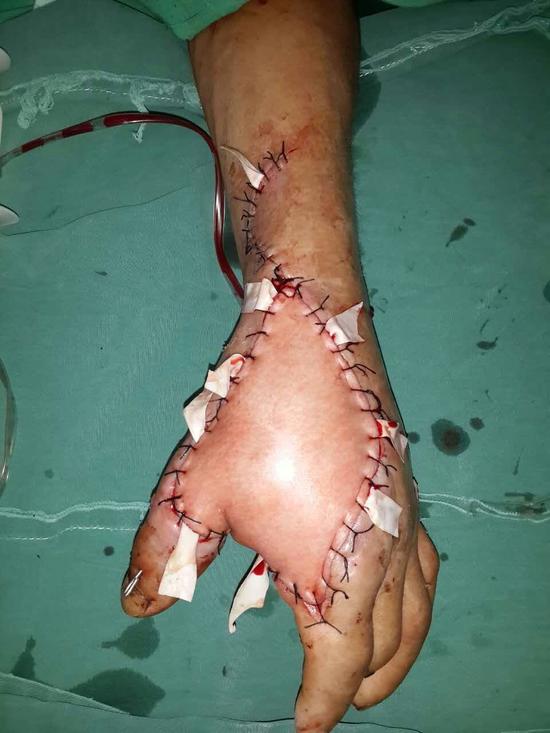 永州村民被五步蛇咬伤肌肉溶解 8小时皮瓣移植手术救回性命