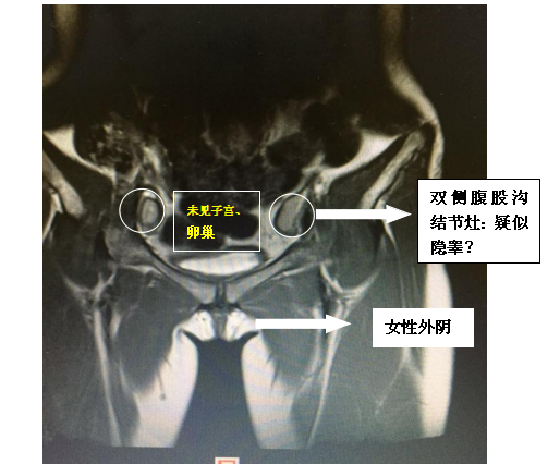 圆圈内为疑似隐睾的组织。