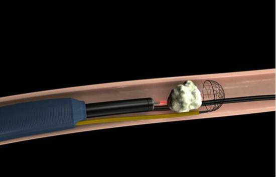 结石梗阻四部位 长沙男子获无创取石技术一次“贯通”