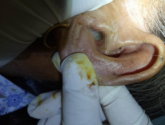 湘西76岁婆婆蛆虫从耳朵爬出 医生掏出时活蹦乱跳