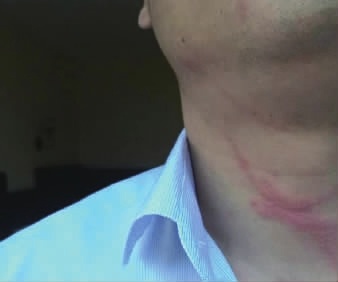隐翅虫一旦接触就可能引起皮肤坏死，图为李先生脖子上的条状红斑。通讯员供图