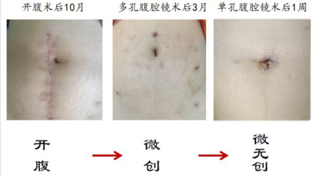 ⬆️不同手术方式创口恢复情况对比