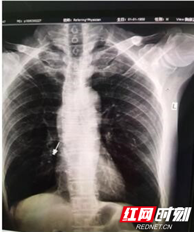 胸片示异物。